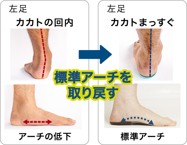 カカトの回内→カカトまっすぐ「標準アーチを取り戻す」