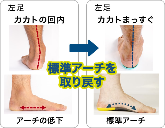 カカトの回内→カカトまっすぐ「標準アーチを取り戻す」