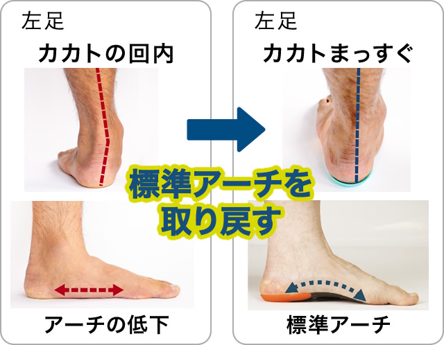 カカトの回内→カカトまっすぐ「標準アーチを取り戻す」