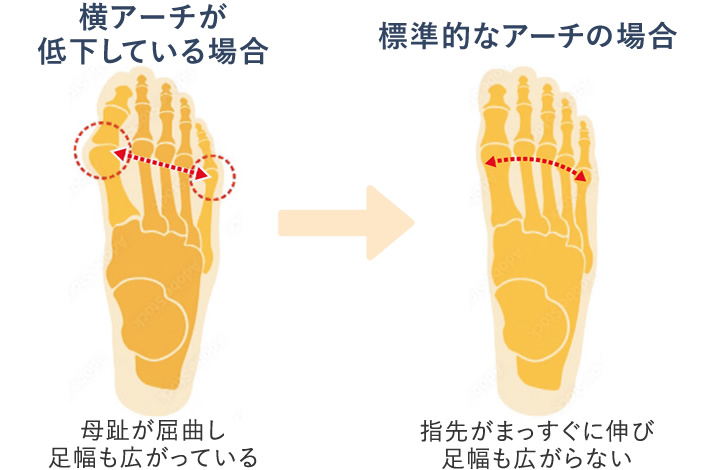 横アーチが低下している場合